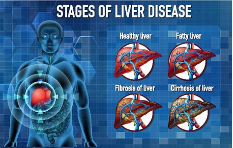 Stages Of Liver Disease Graphic Normal Pathology Vector, Graphic ...