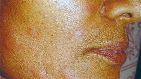 Preventive Medicine: Tiny Rash On Face And Neck