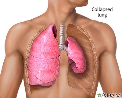 Collapsed lung, pneumothorax: MedlinePlus Medical Encyclopedia Image