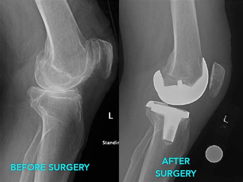 Total Knee Arthroplasty | Rodriguez Hip and Knee