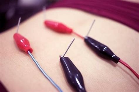 Dry Needling For Tendonitis Pain Relief - Does It Work? | Primal Physical Therapy