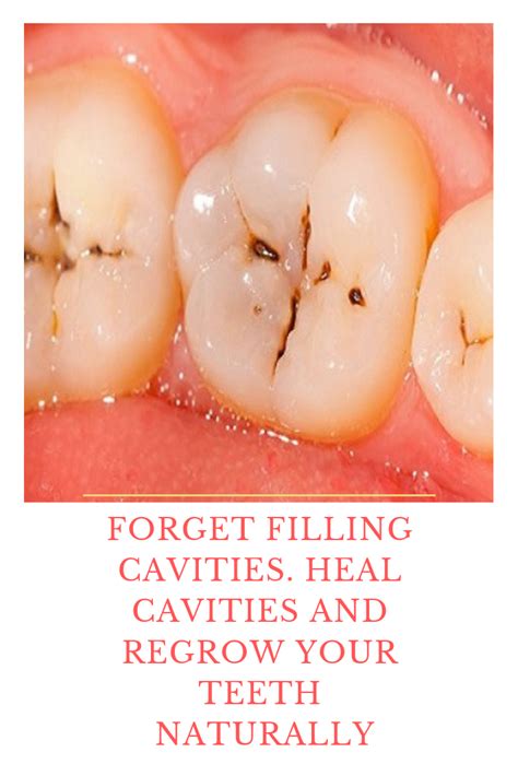 Pin by theonie davis on Beauty & Health ^ | Heal cavities, Organic remedy, Cure tooth decay