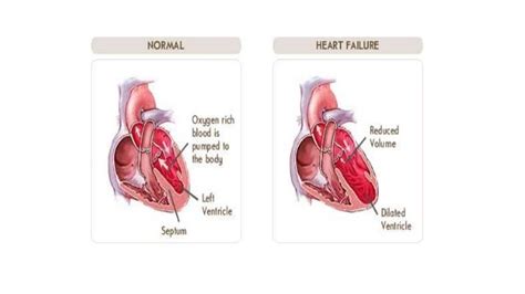 Complications of cardiac surgery