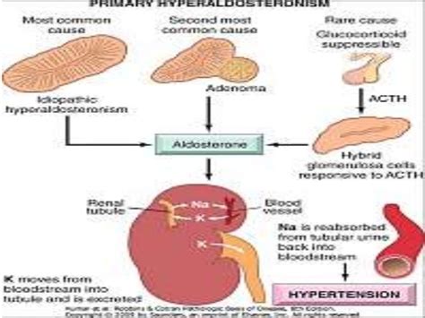 ALDOSTERONISM