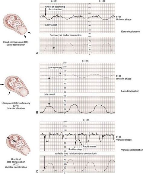 fetal heart rate monitor interpretation | Newborn nursing, Nursing school survival, Midwifery ...