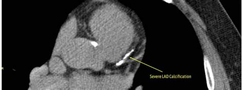 Coronary Calcium Score (Coronary Artery Calcification): Nuts and Bolts - Heartcare Sydney