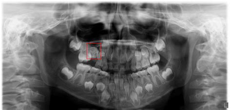 Panoramic x-ray of mixed dentition, can't figure out which tooth this is : askdentists