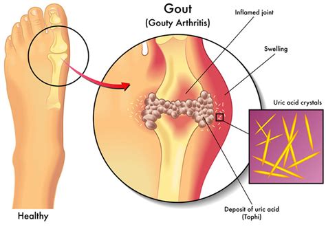 What Are The Symptoms Of Hyperuricemia? - Get Rid Of Gout