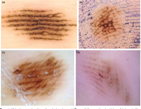 Key points in dermoscopic differentiation between early acral melanoma and acral nevus ...