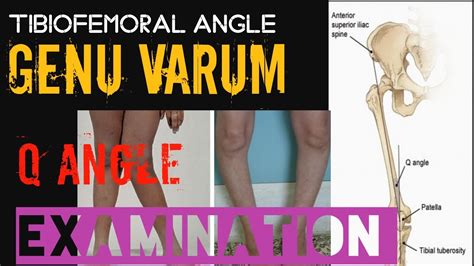 Tibiofemoral angle #q angle#genu varum#genuvalgum#knee#anatomical axis - YouTube