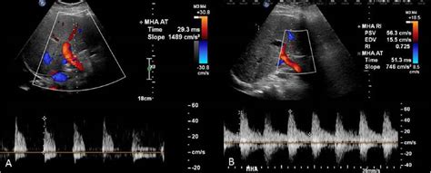 Hepatic Vein Doppler Ultrasound