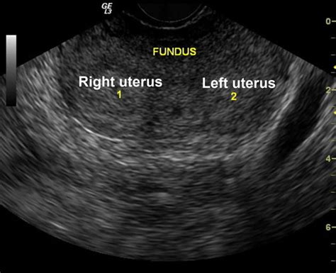 Bicornuate Uterus - Causes, Symptoms, Ultrasound, Fertility & Pregnancy