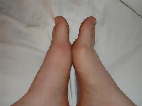 How To Diagnose Gout In Knee Gout Pain Treatment | LONG HAIRSTYLES