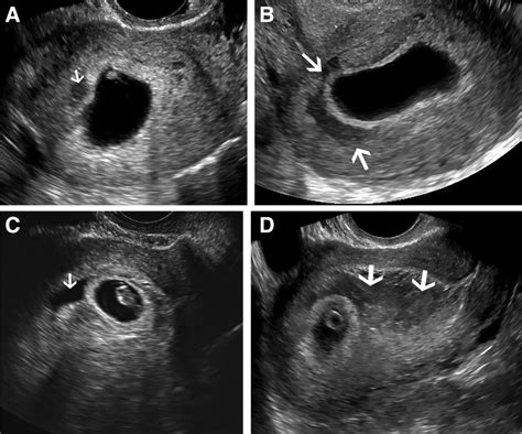 Subchorionic Hematoma: Correlation of Grading Techniques With First ...