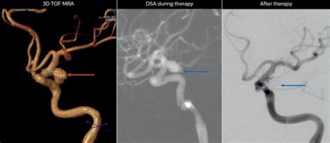 Aneurysms with 3D TOF MRA - FieldStrength MRI | Philips Healthcare