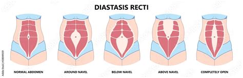 Diastasis Recti six pack separation belly rectus Linea alba abdominal surgical Tummy Tuck skin ...