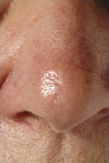 Morphoeic basal cell carcinoma on nasal tip | Open-i