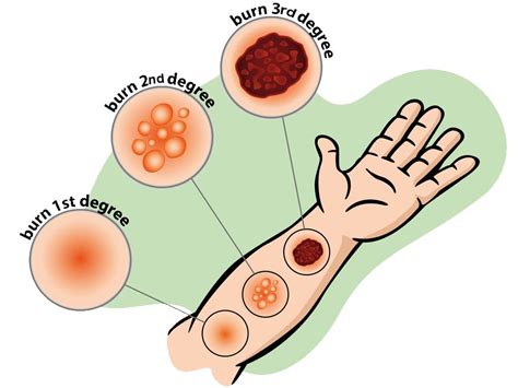 how to treat a 3rd degree burn - Mistery Paper