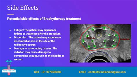 PPT - Brachytherapy_slidesgpt PowerPoint Presentation, free download - ID:12063051