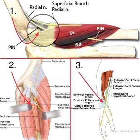 Forearm Radial Nerve Entrapment: 3 varieties. Tennis elbow mimics! 1. Radial Tunnel Syndrome ...