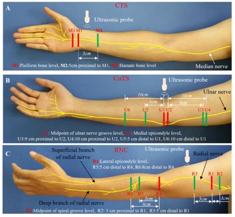 Radial Nerve Block Ultrasound