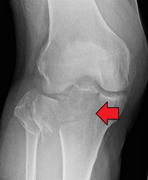 Anterior Cruciate Ligament (ACL) Injury - Physiopedia