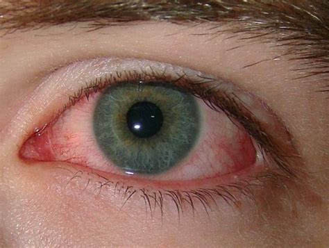 👉 Scratched Eye - Symptoms, Home Treatment and Causes (January 2022)