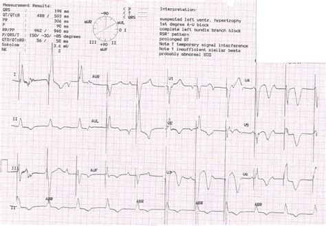 Dr. Smith's ECG Blog: Giant Inverted T waves in an Elderly Patient