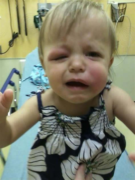 Skeeter Syndrome is a real thing! My poor Baby!! : WTF