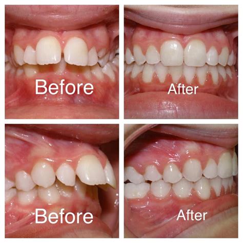 Transform Your Smile with Braces and MARA Appliance