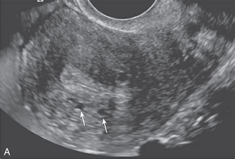 Endometrial/junctional zone thickening | Radiology Key