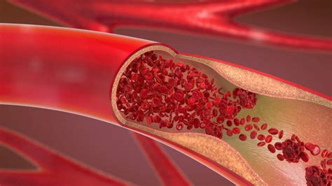 Many Heart Surgeries Are Unwarranted for Blocked Arteries, Finds New Study