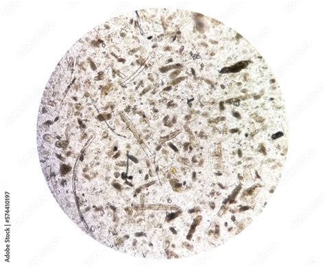 Microscopic urine examination showing Granular cast, a sign of many ...