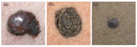 Three examples of pigmented skin lesions: (a) melanoma, (b) seborrheic... | Download Scientific ...