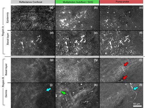 Detecting melanoma early, without a biopsy | SOURCE | Colorado State University