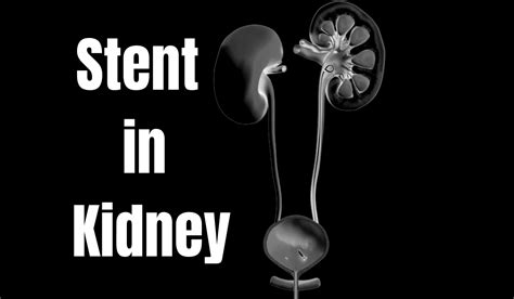 What You Need to Know About Stent in Kidney | Littlemedi.com