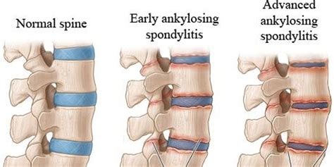 Symptoms of Ankylosing Spondylitis | by Rashika Naman | Medium