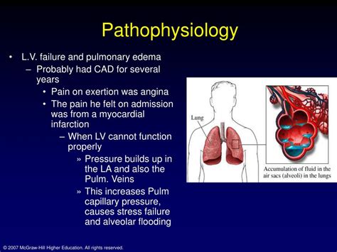 Pulmonary Edema Pathophysiology