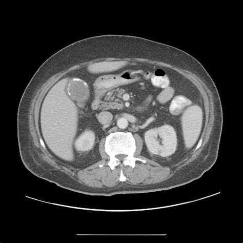 Porcelain gallbladder - wikidoc