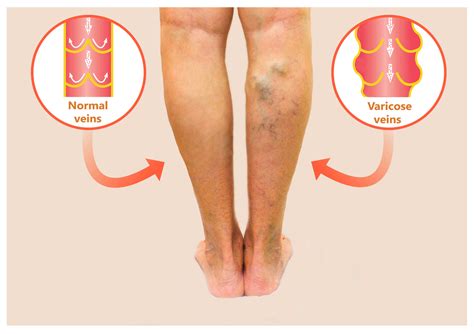 Alternative Treatment for Varicose Veins - Bulging Veins in Legs Treatment