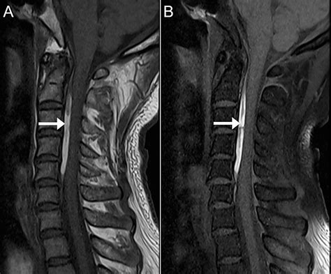 Cureus | Spontaneous Cervical Epidural Hematoma Following COVID-19 ...