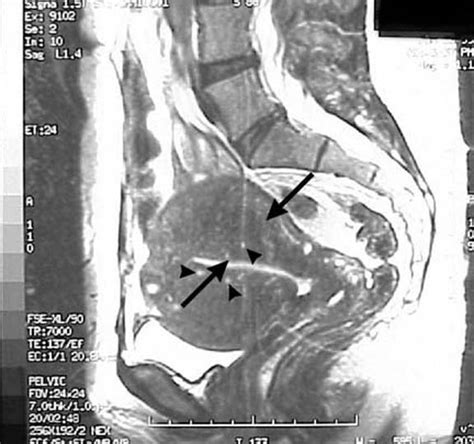 adenomyosis_mri.jpg [Nick's Radiology Wiki]