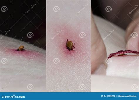 Tick with Its Head Sticking in Human Skin Stock Photo - Image of ...