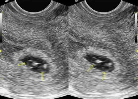 Twins Ultrasound 6 Weeks