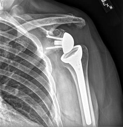 The Why and When of Shoulder Replacement Surgery - Arthritis Advisor