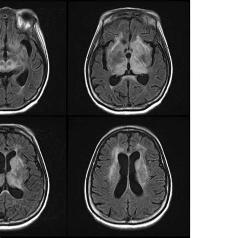 (PDF) Central Nervous System Peripheral T Cell Lymphoma Manifesting as ...