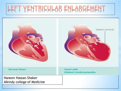 Left ventricular enlargement radiology