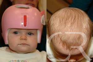 Plagiocephaly - Kentucky Center for Cosmetic & Reconstructive Surgery