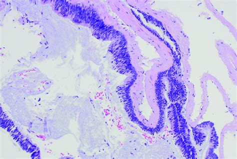 Histologic slide from cold forceps biopsy (H&E, orig. mag. Â 10). | Download Scientific Diagram