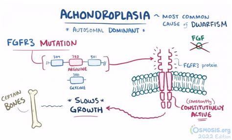 Achondroplasia Symptoms And Characteristics